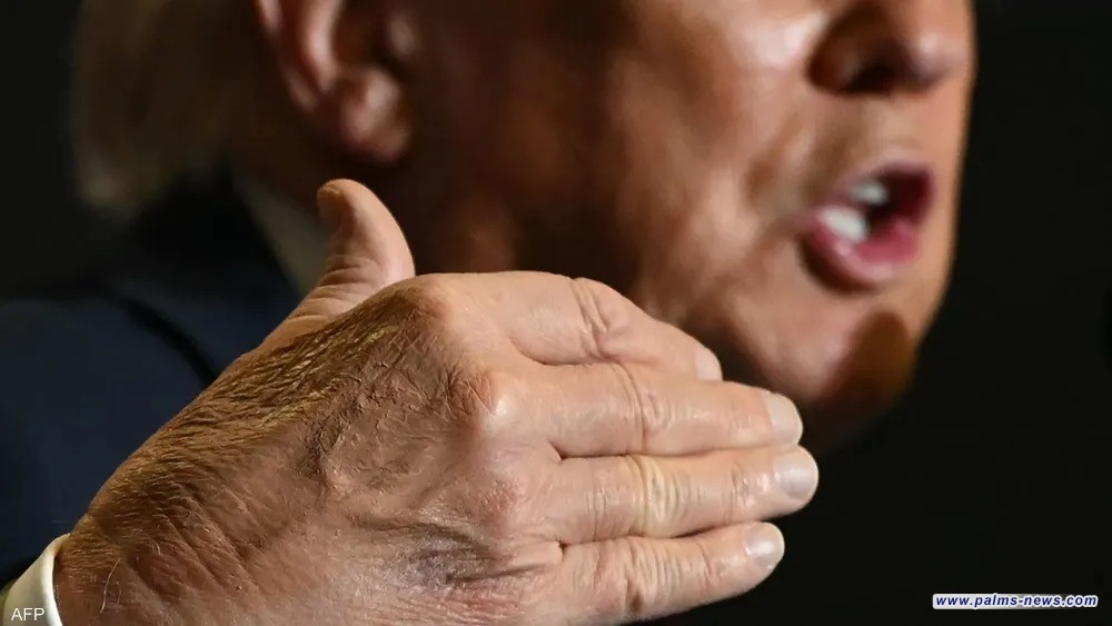 ترامب يكسّر صمته بشأن سبب ظهور كدمات على يده